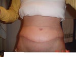 scar is way above my hips